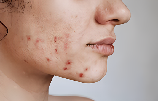 Efficacy and tolerability of liposomal polyvinylpyrrolidone-iodine hydrogel for the localized treatment of chronic infective, inflammatory dermatoses