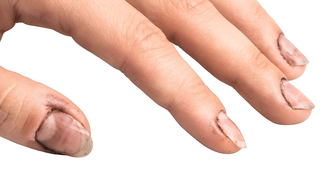 Bacterial nail infection with green or yellow discolouration — symptoms, causes, and treatment