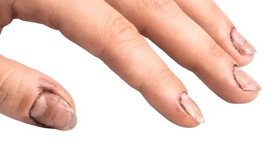 Bacterial nail infection with green or yellow discolouration — symptoms, causes, and treatment
