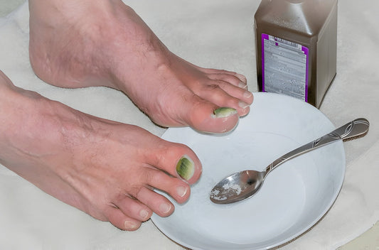 Bare feet with green discolouration across both big toenails, next to a plate, a spoon of white powder and an unlabelled bottle set out as a home remedy