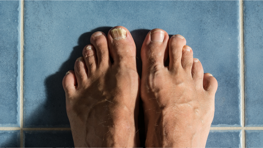 Iodine Pure vs. Jublia for Toenail Fungus