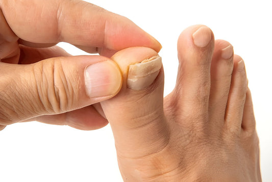 Types of Toenail Fungus