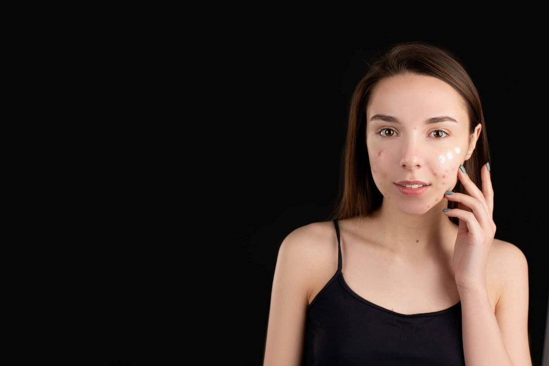 Teen acne treatment with natural iodine-based EZ Clear Skin spray — clearer skin for teenagers