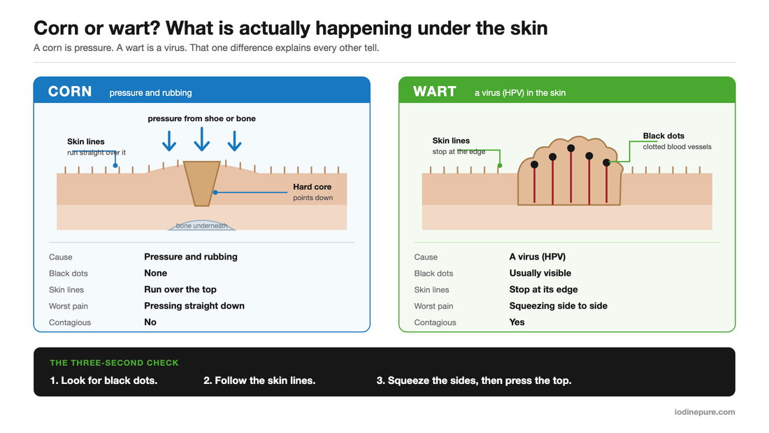 Cross-section diagram comparing a corn and a wart in the skin, showing the corn's hard keratin core over bone with skin lines running over it, and the wart's black dots with skin lines stopping at its edge.