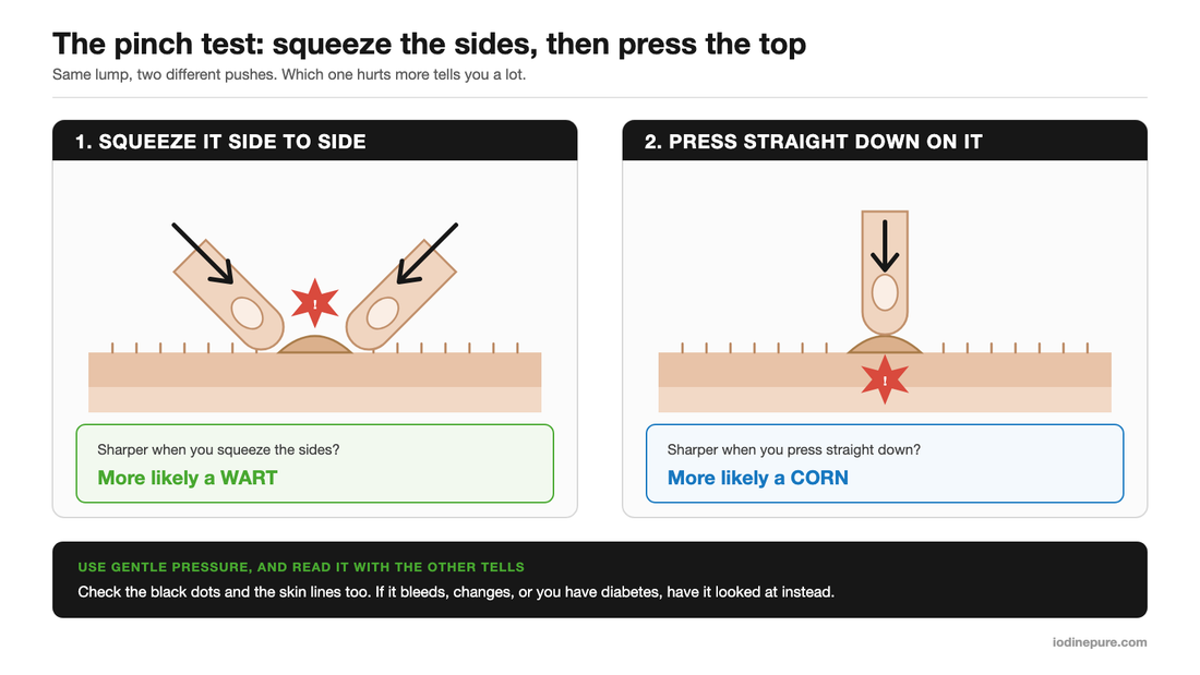 Diagram of the corn vs wart pinch test, showing two fingers squeezing a lump from the sides in one panel and one finger pressing straight down on it in the other.