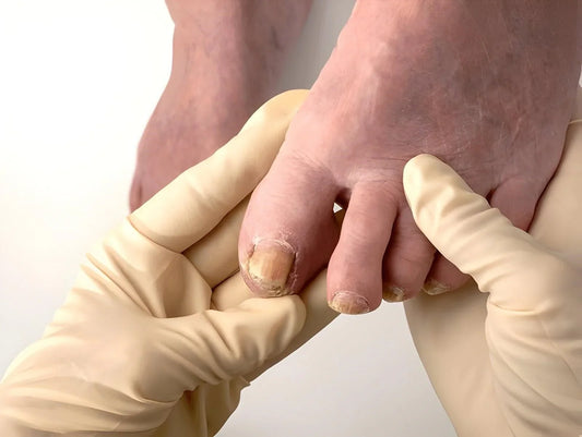 Close up of a damaged, discoloured toenail, the kind of nail ointments like Terrasil are applied to