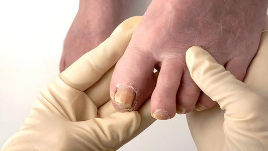 Foot care clinician in gloves separating the toes of a foot with thickened, yellow-brown discoloured toenails