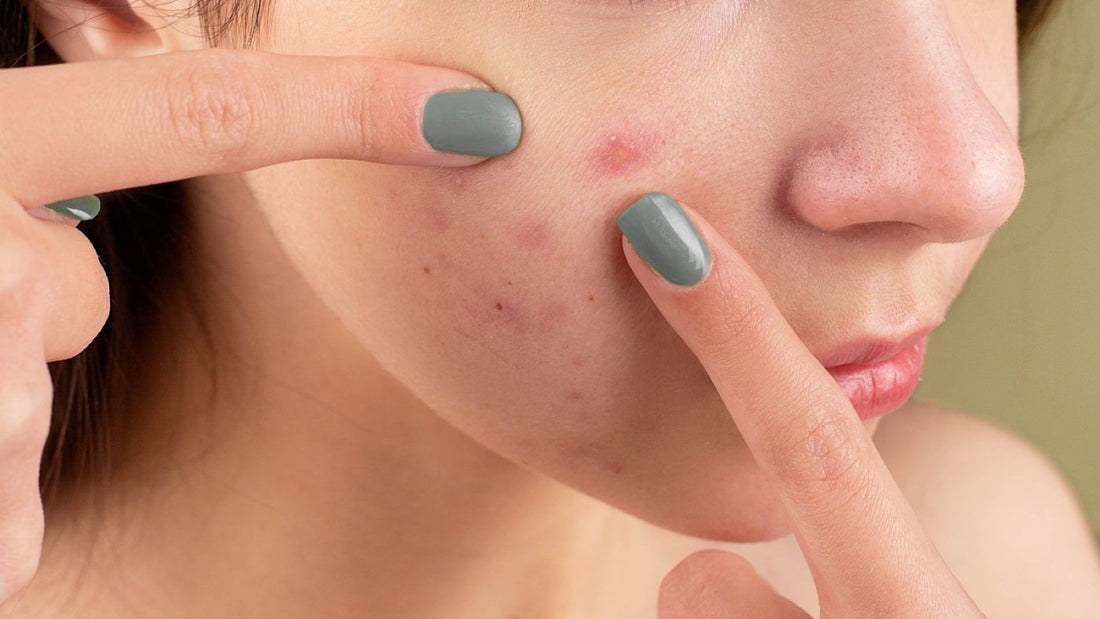 Woman examining small uniform breakouts on her cheek - fungal acne vs regular acne