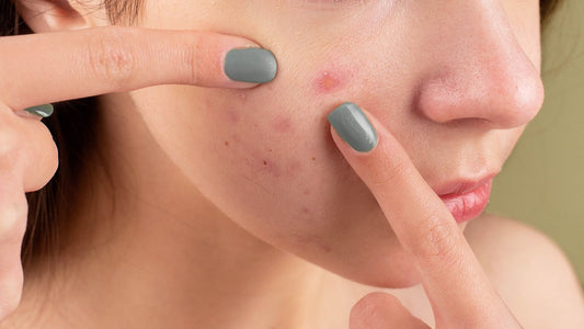 Woman examining small uniform breakouts on her cheek - fungal acne vs regular acne