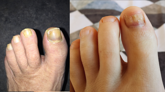 Two side by side photographs of bare feet with thickened, yellow and brown discoloured toenails
