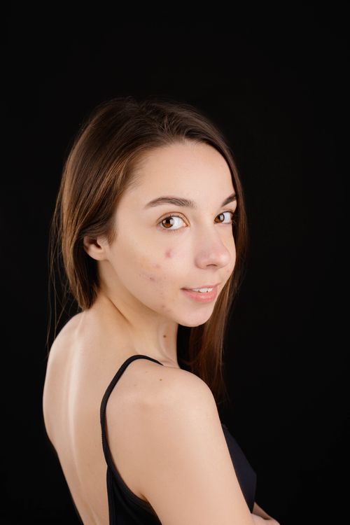 Teenager with skin concerns — teen acne treatment guide comparing what actually works