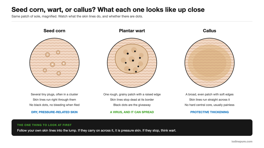 Magnified comparison of a seed corn, a plantar wart and a callus, showing tiny plugs with skin lines running through, a rough patch with black dots, and broad even thickening.