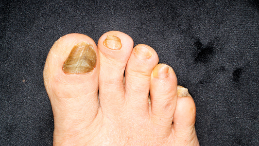Thick, yellow, discoloured toenails before starting a daily iodine soak and spray routine