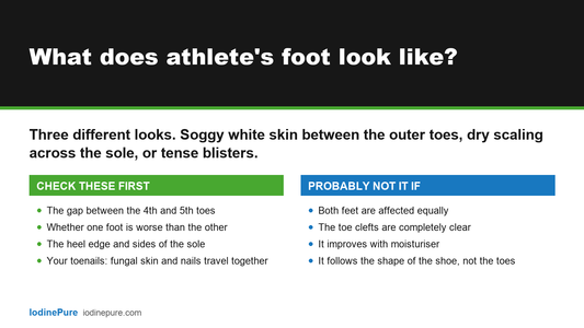 Answer card: what does athlete's foot look like? Check the gap between the fourth and fifth toes, whether one foot is worse, the heel edge and your toenails.