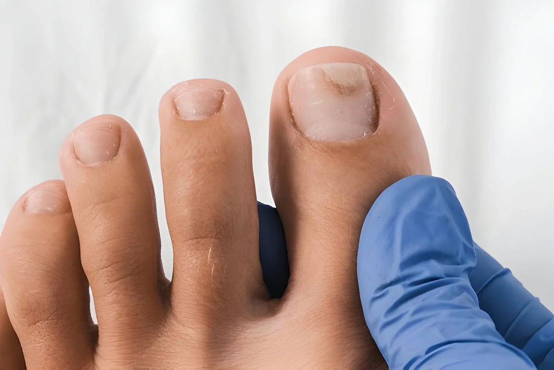 A damaged toenail, the nail people cover with press-ons and what to know before gluing