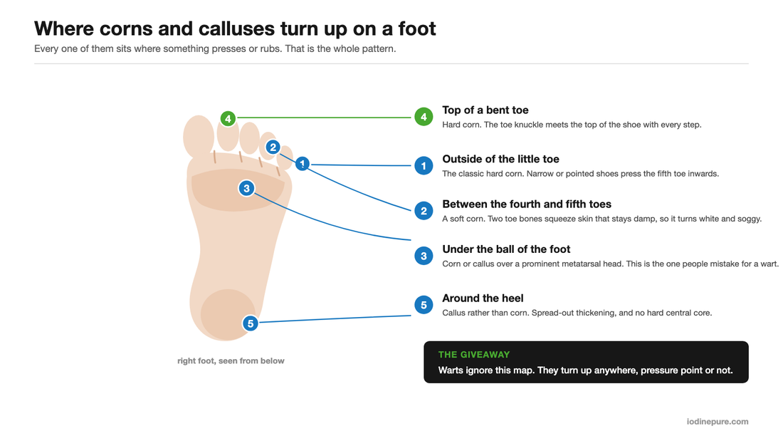 Map of a right foot showing where corns and calluses form, including the outside of the little toe and the web space between the fourth and fifth toes.