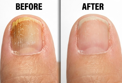 Before and after comparison of a fingernail with fungus with and without a treatment.
