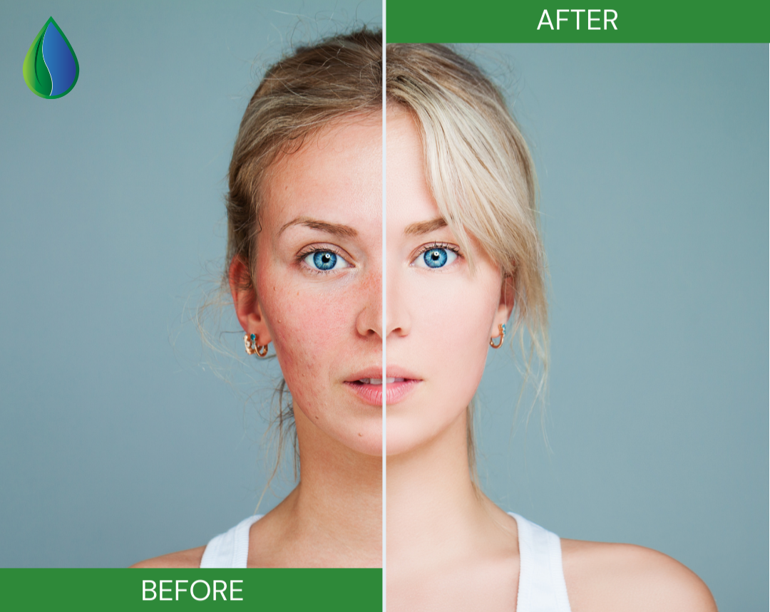 blonde girl with blue eyes before and after curing her acne blemishes