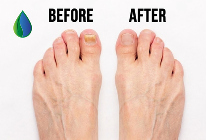 Before and after comparison of feet with foot fungus with a focus on foot care product.