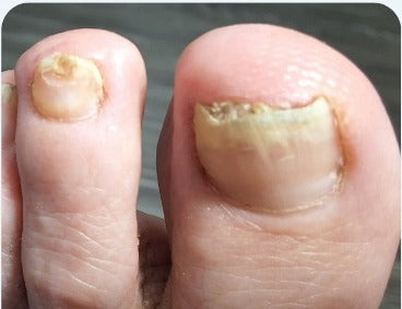 Toenails at day 0 before starting the IodinePure routine, photographed at Whole Health Care