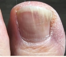 Client toenail at day 0 in April, visible discolouration, Whole Health Care progress series
