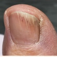 Client toenail at day 30 in May, Whole Health Care progress series