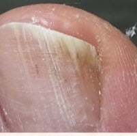 Client toenail at day 60 in July, Whole Health Care progress series