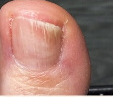 Client toenail at day 90 in September, Whole Health Care progress series
