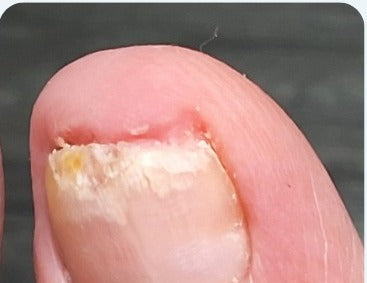 The same toenail at week 6 of the IodinePure routine, photographed at Whole Health Care