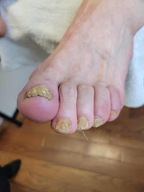 Toenails before starting the IodinePure routine, photographed at Sarah-Ann's Foot Care