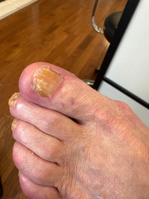Toenail progress during the IodinePure routine, Sarah-Ann's Foot Care client
