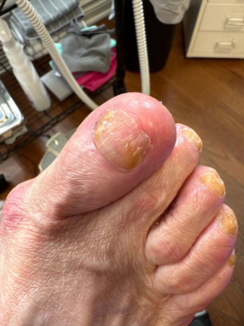 Close-up of toenail progress during the IodinePure routine, Sarah-Ann's Foot Care client