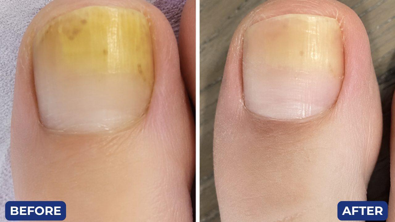 Before and after, toenail fungus