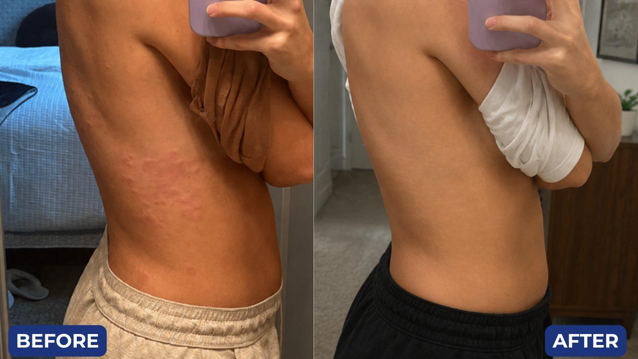 Before and after, rash