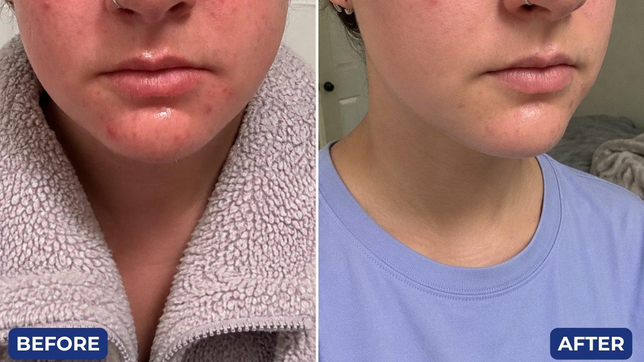 Before and after, acne