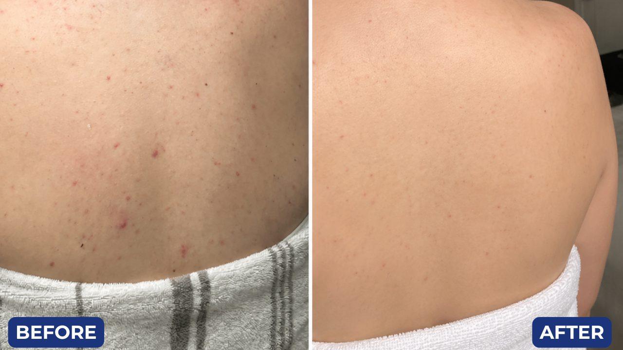 Before and after, acne