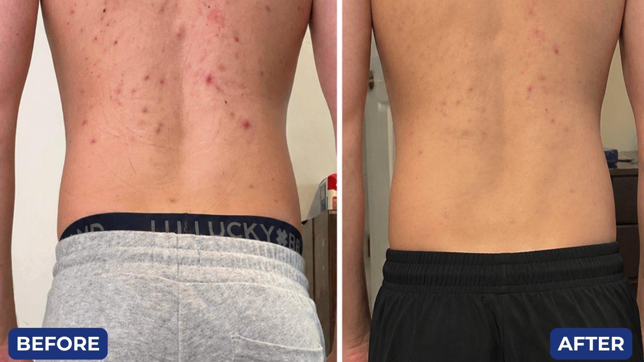 Before and after, back acne