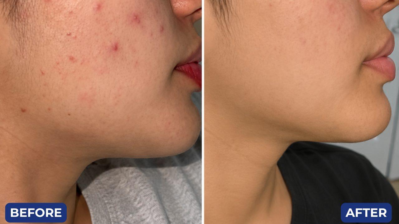 Before and after, acne
