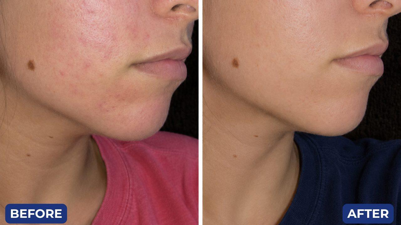 Before and after, acne