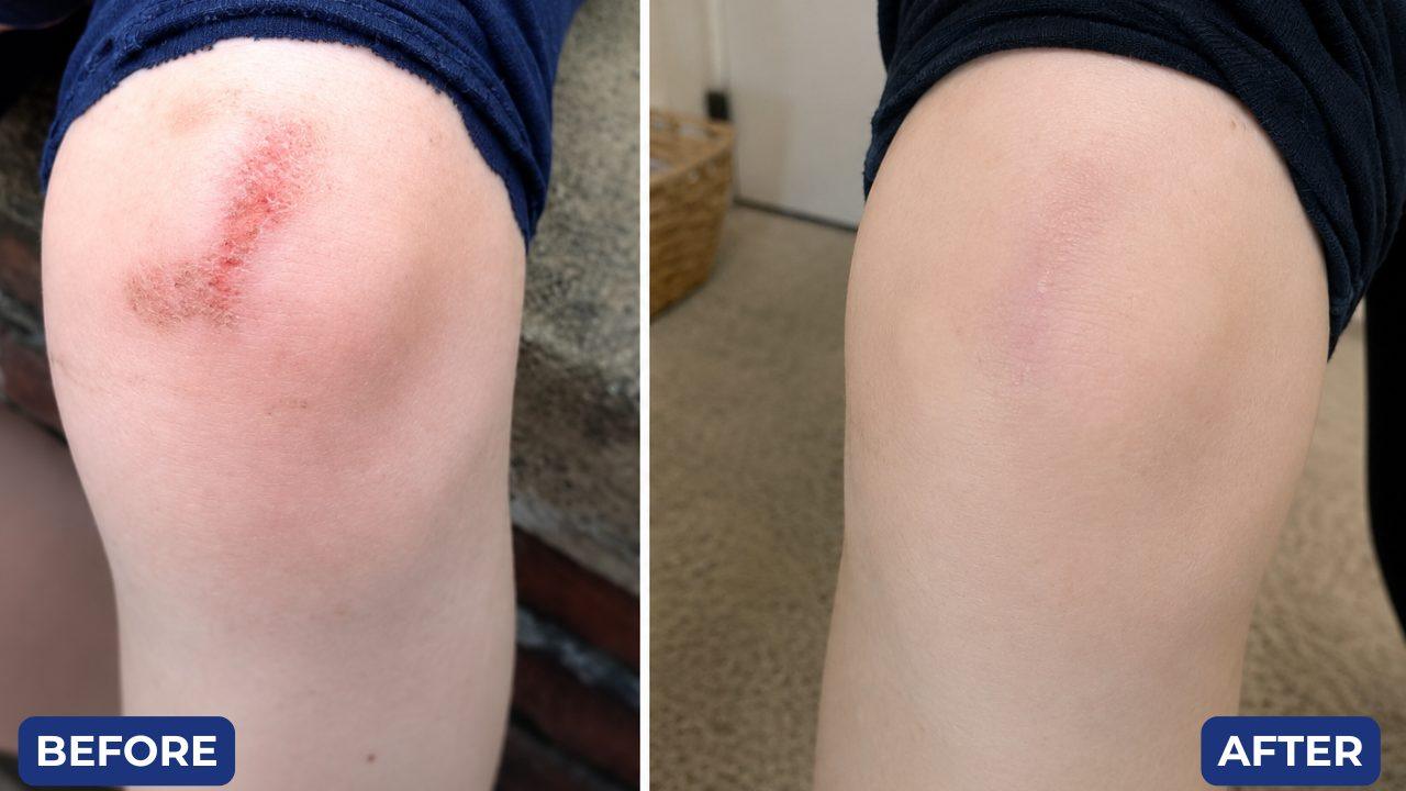 Before and after, grazed knee