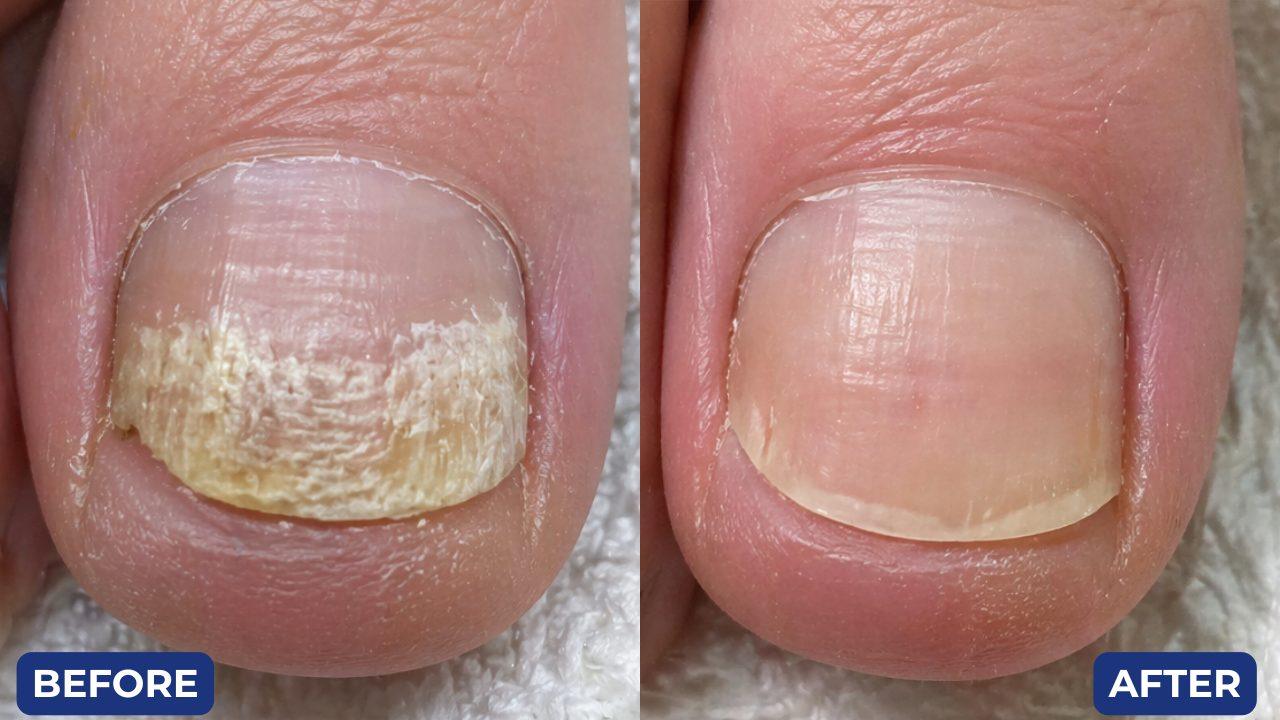 Before and after, toenail fungus