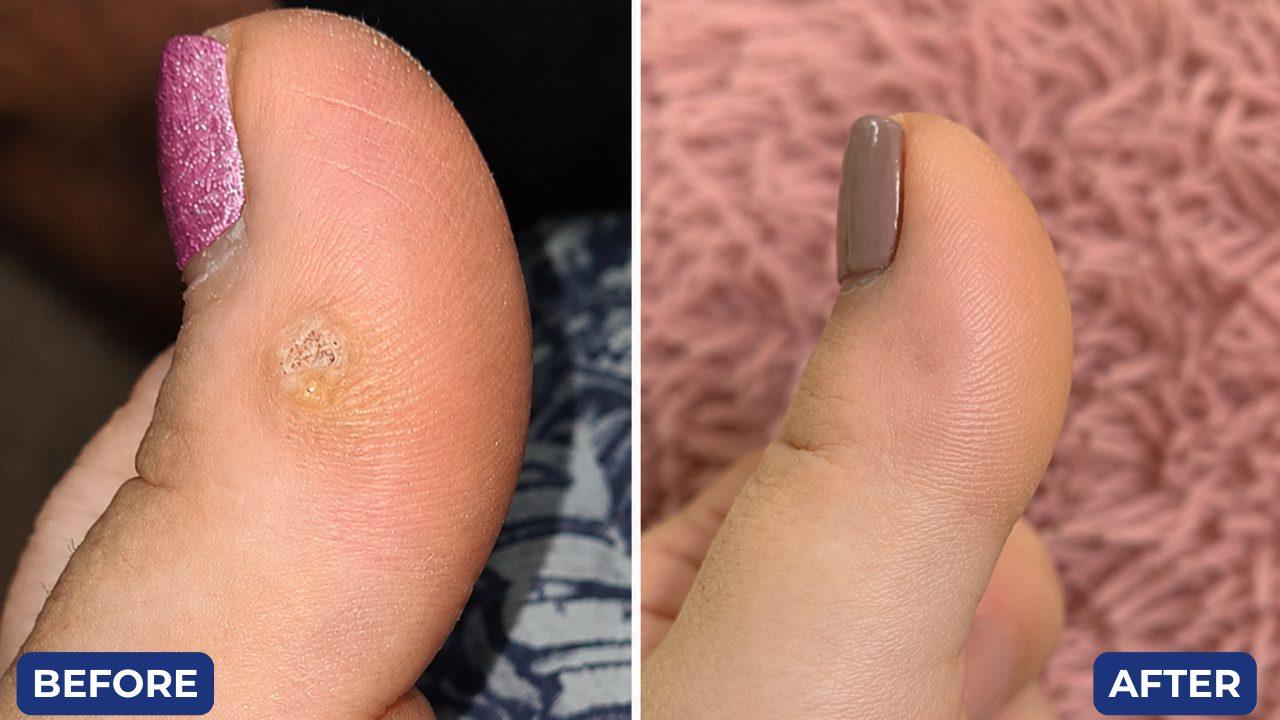 Before and after, wart