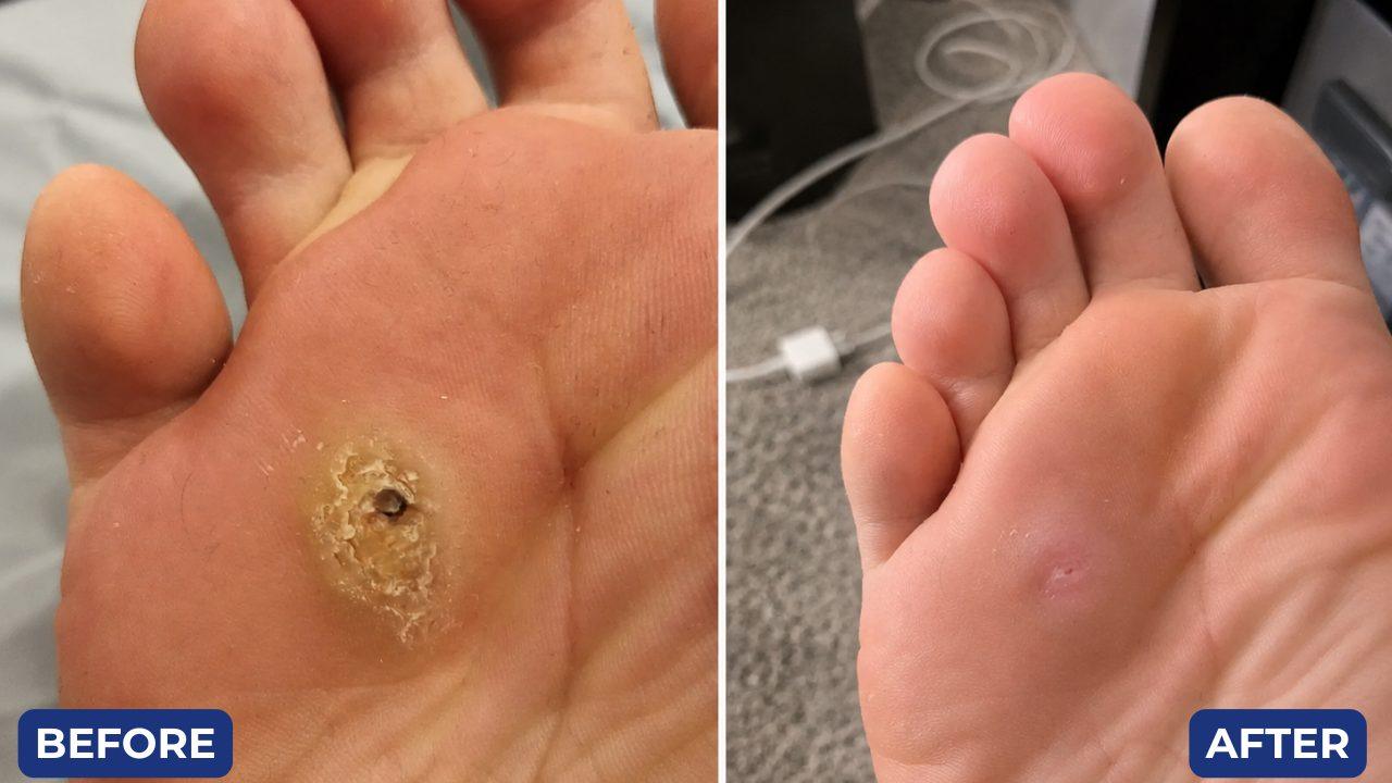 Before and after, plantar wart