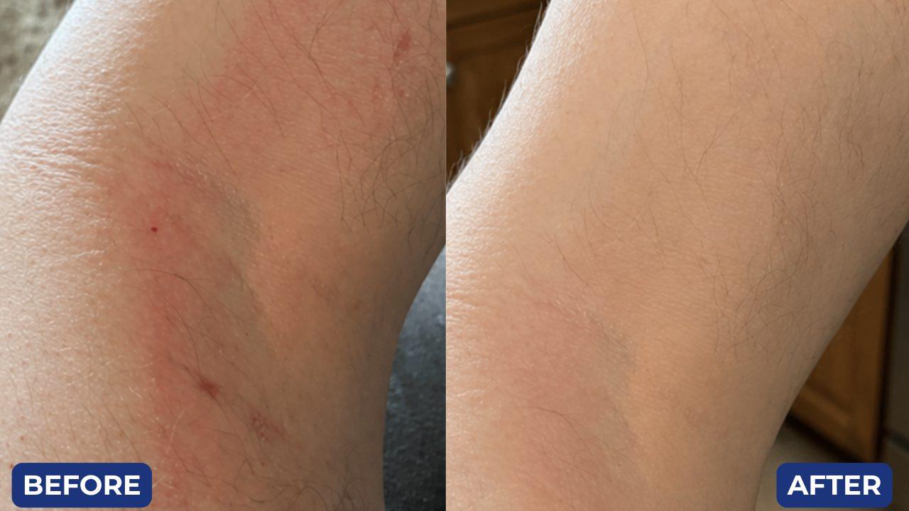 Before and after, rash